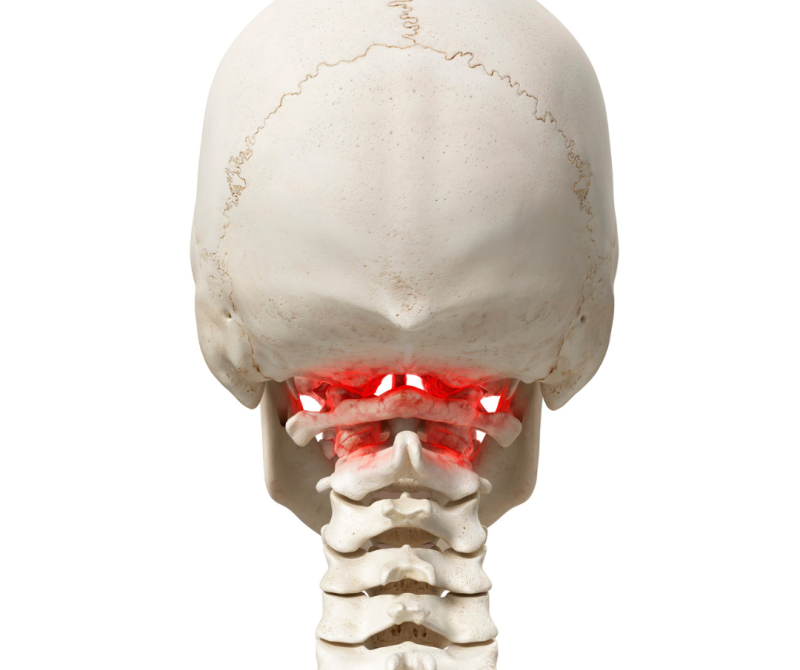 Anatomical model highlighting inflammation in the upper cervical spine, illustrating how misalignment in this region contributes to neck pain, back pain, and vertigo.