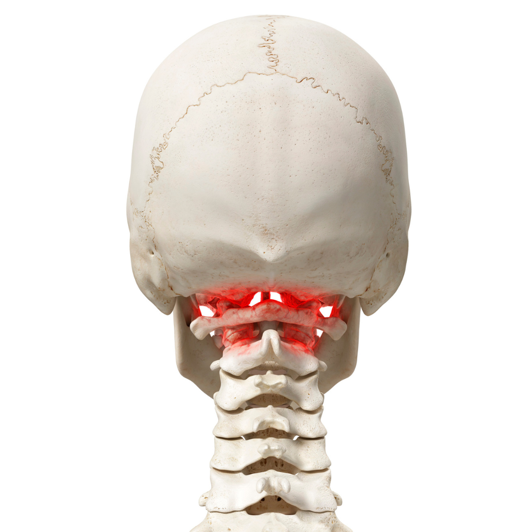 Anatomical model highlighting inflammation in the upper cervical spine, illustrating how misalignment in this region contributes to neck pain, back pain, and vertigo.